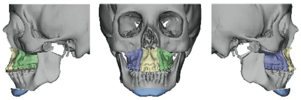 3D CT Reconstruction- Slide 2