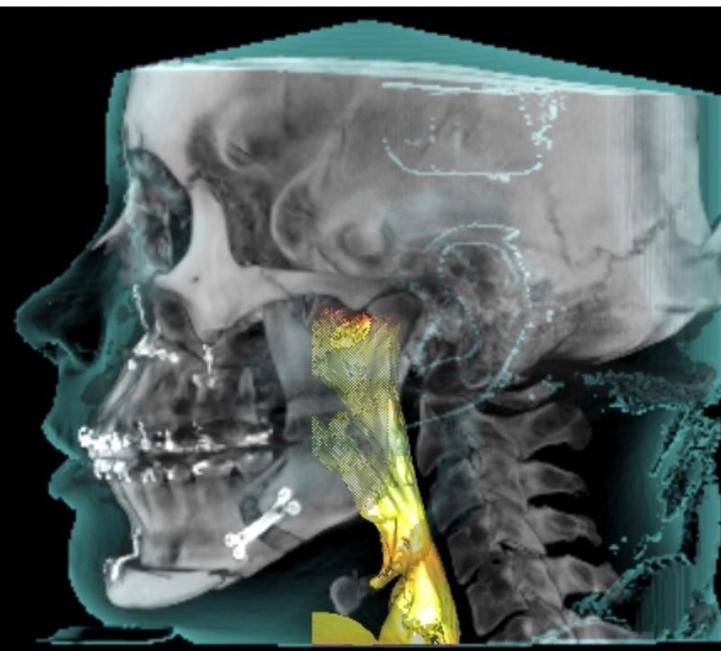 Female Jaw Repositioning for Sleep Apnea- After