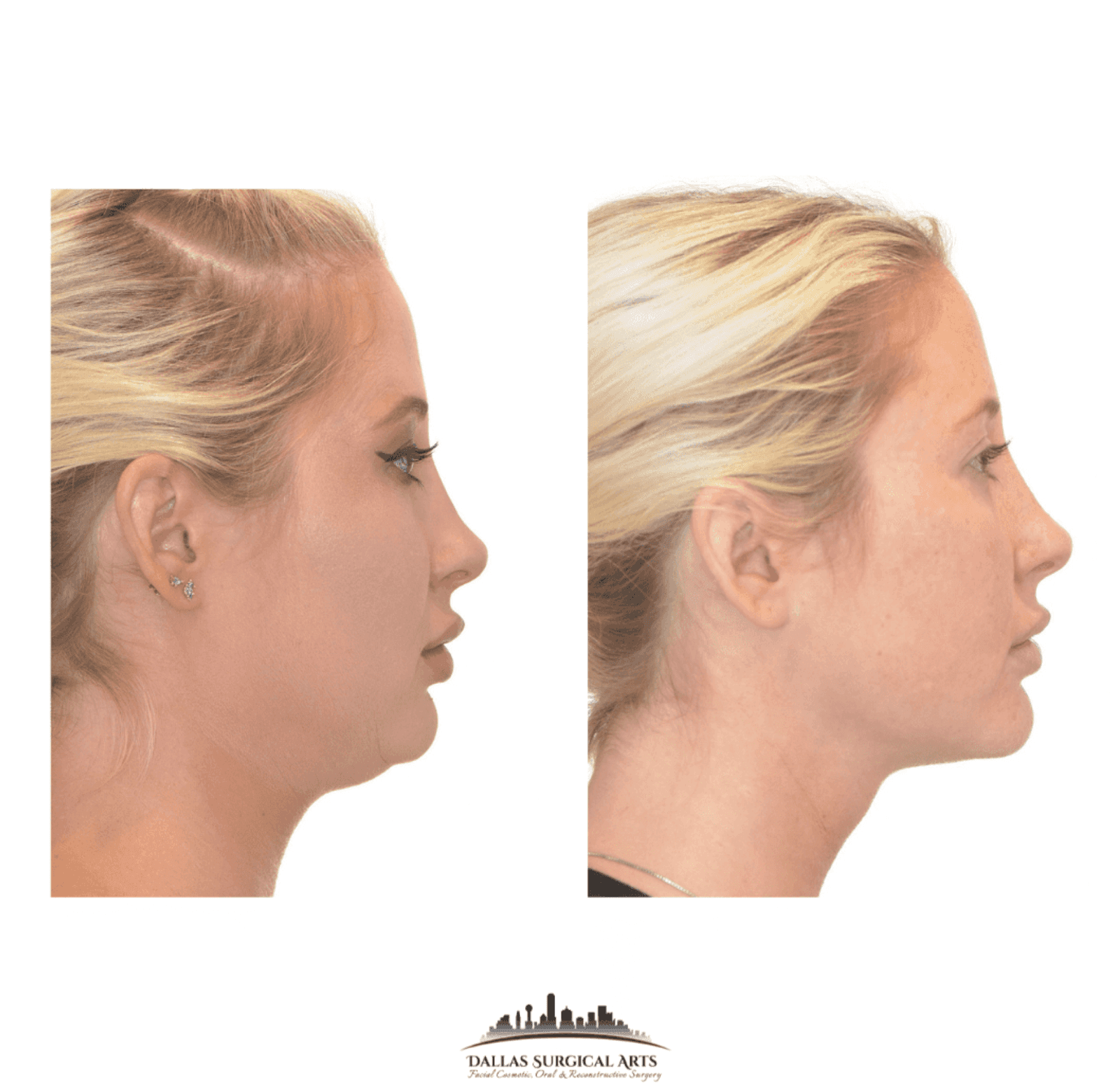Dallas Neck Liposuction Before and After