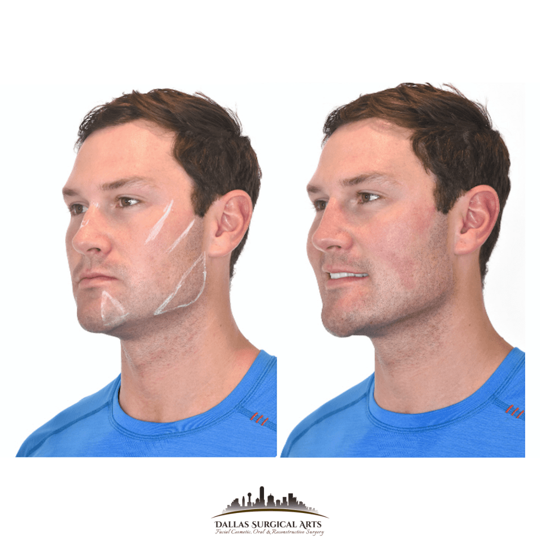 Male Jaw Filler