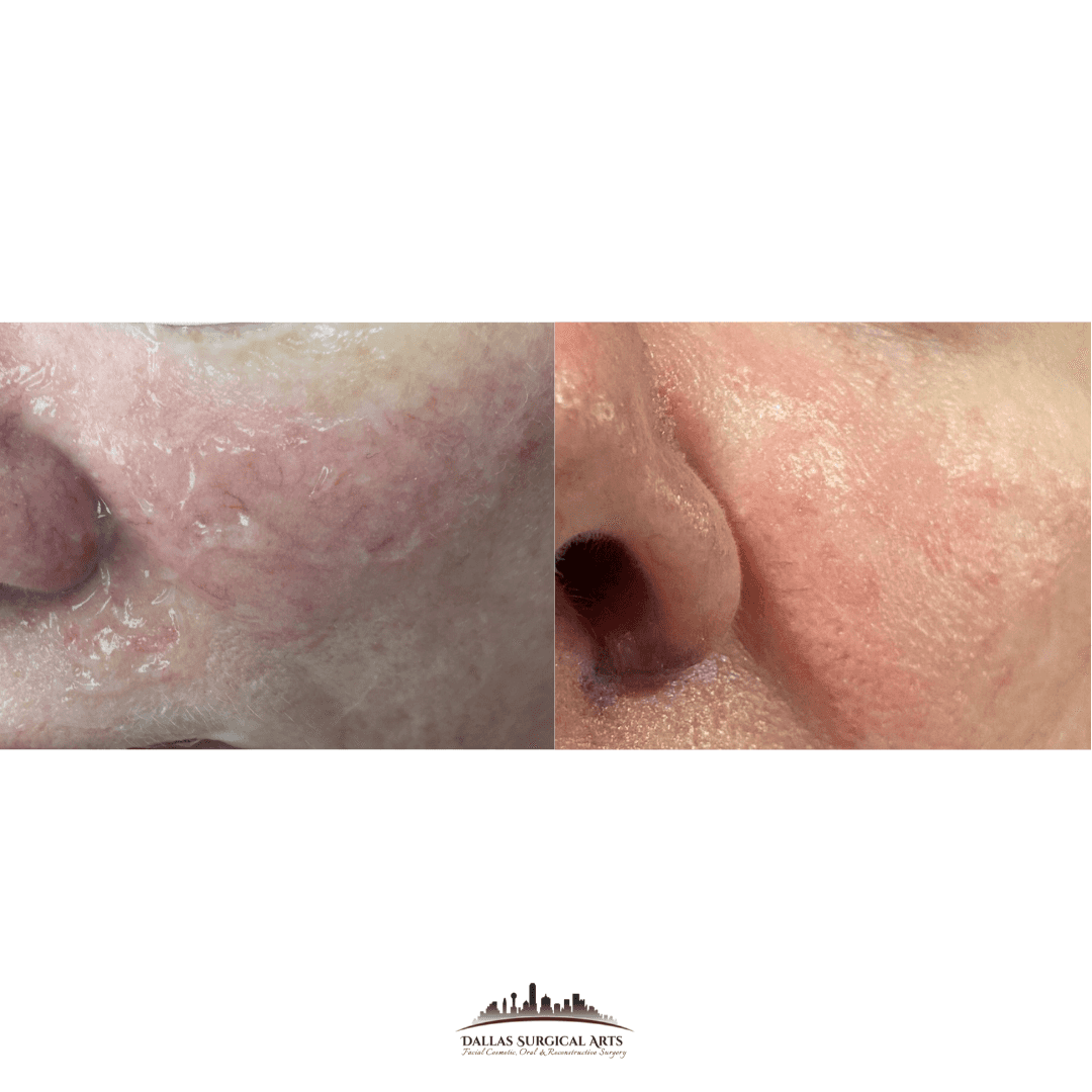 Vbeam Before And After Facial Veins