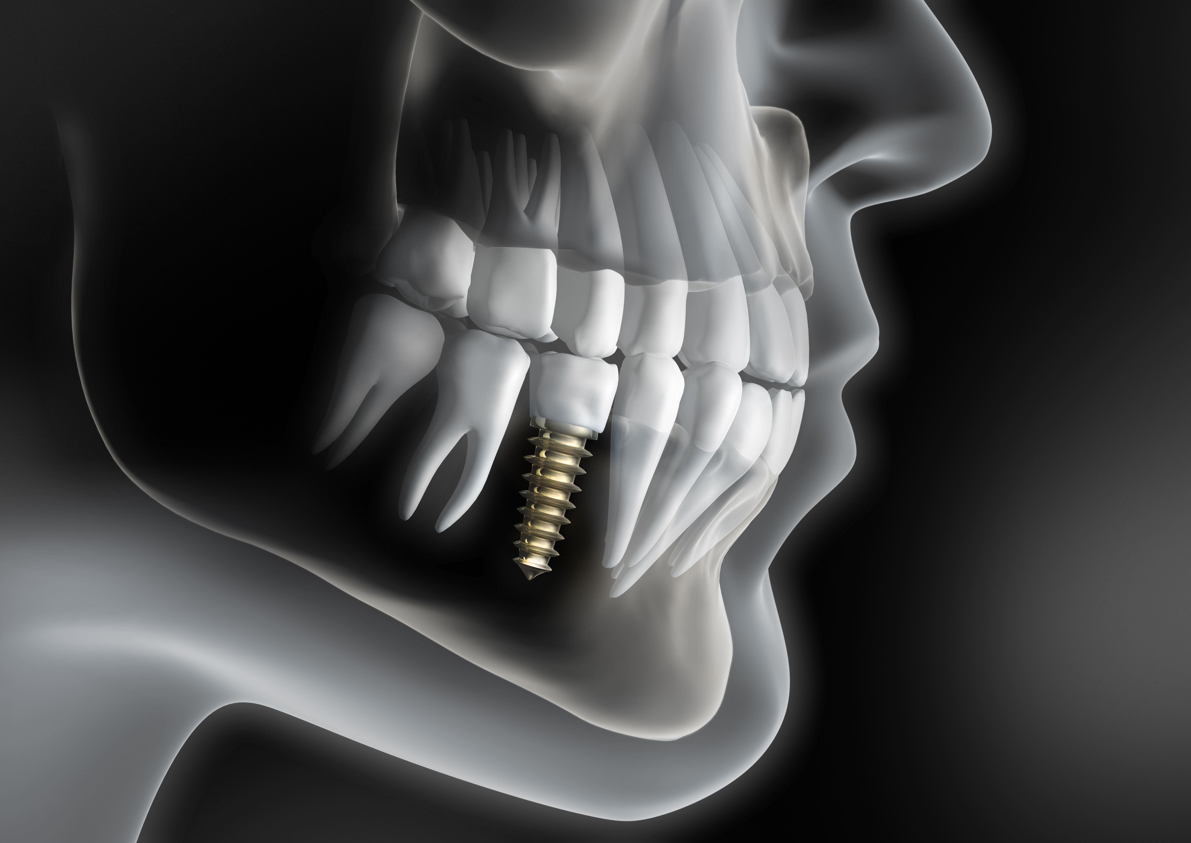 Dental Implant