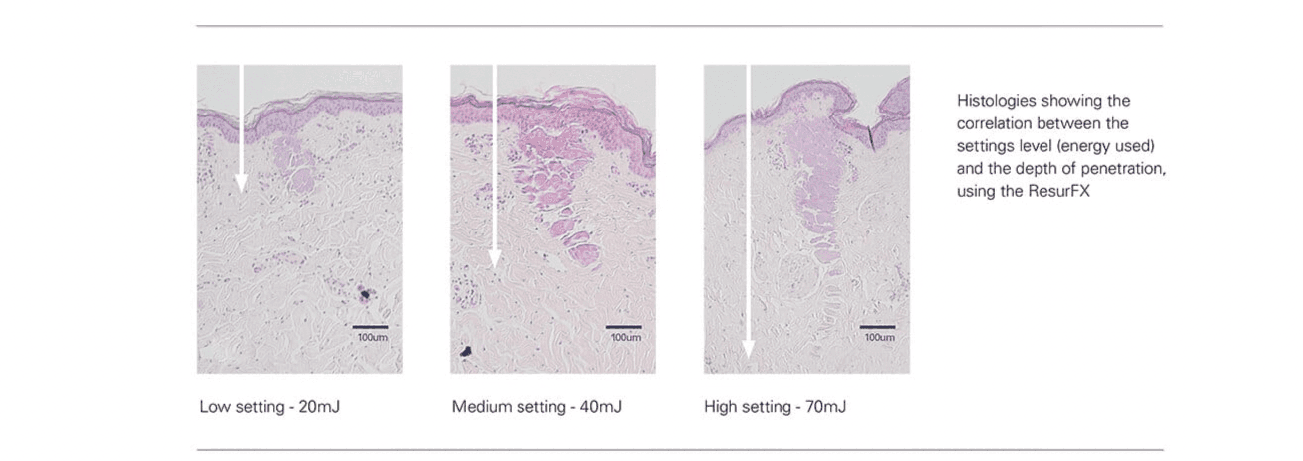 Lumenis® Photofractional™ Treatment