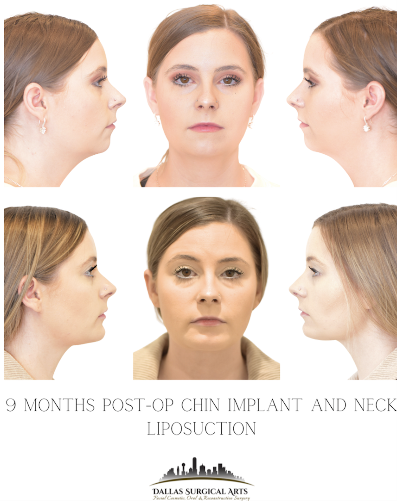 Double Chin Removal: Sculpt Your Profile with Precision