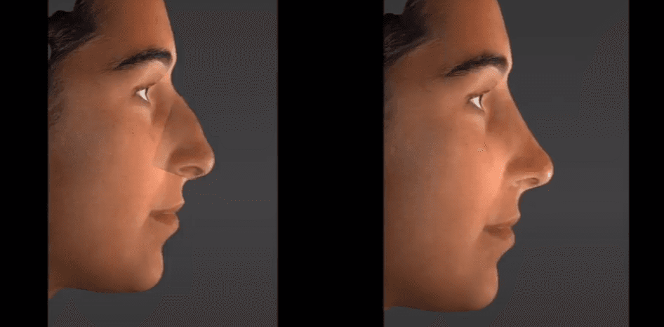 3D Technology to Improve Outcomes of Cosmetic Surgery at Dallas Surgical Arts