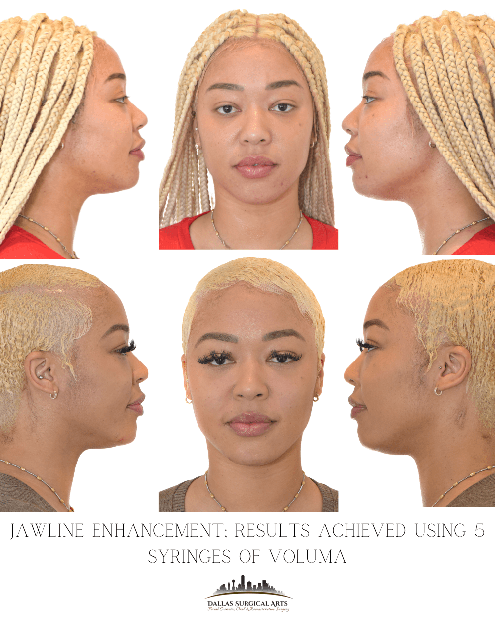 Jawline Fillers - Contouring Your Chin in Dallas