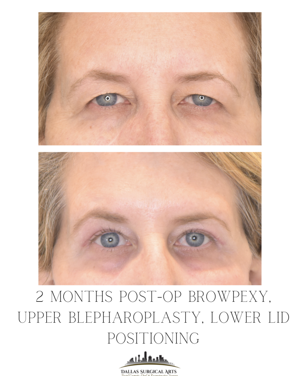 Life-Changing Effects of a Brow Lift in Dallas, Texas