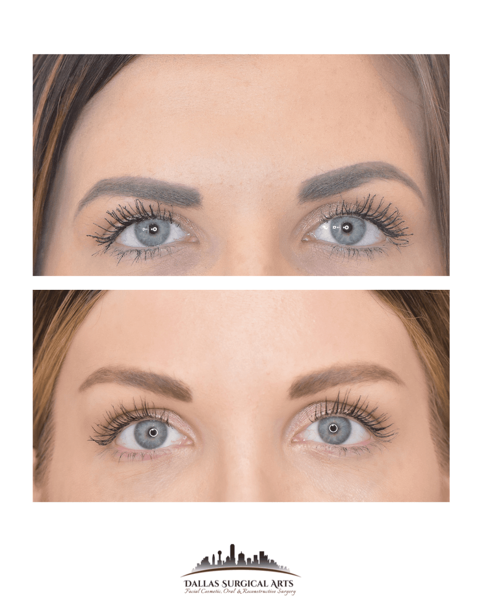 Refresh Your Appearance with Blepharoplasty and Brow Lift Surgery in Dallas