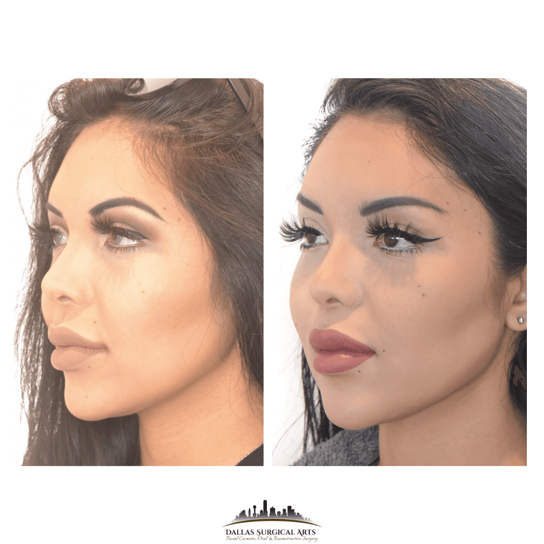 Enhance Facial Contours with Buccal Fat Removal by Dr. Randy Sanovich