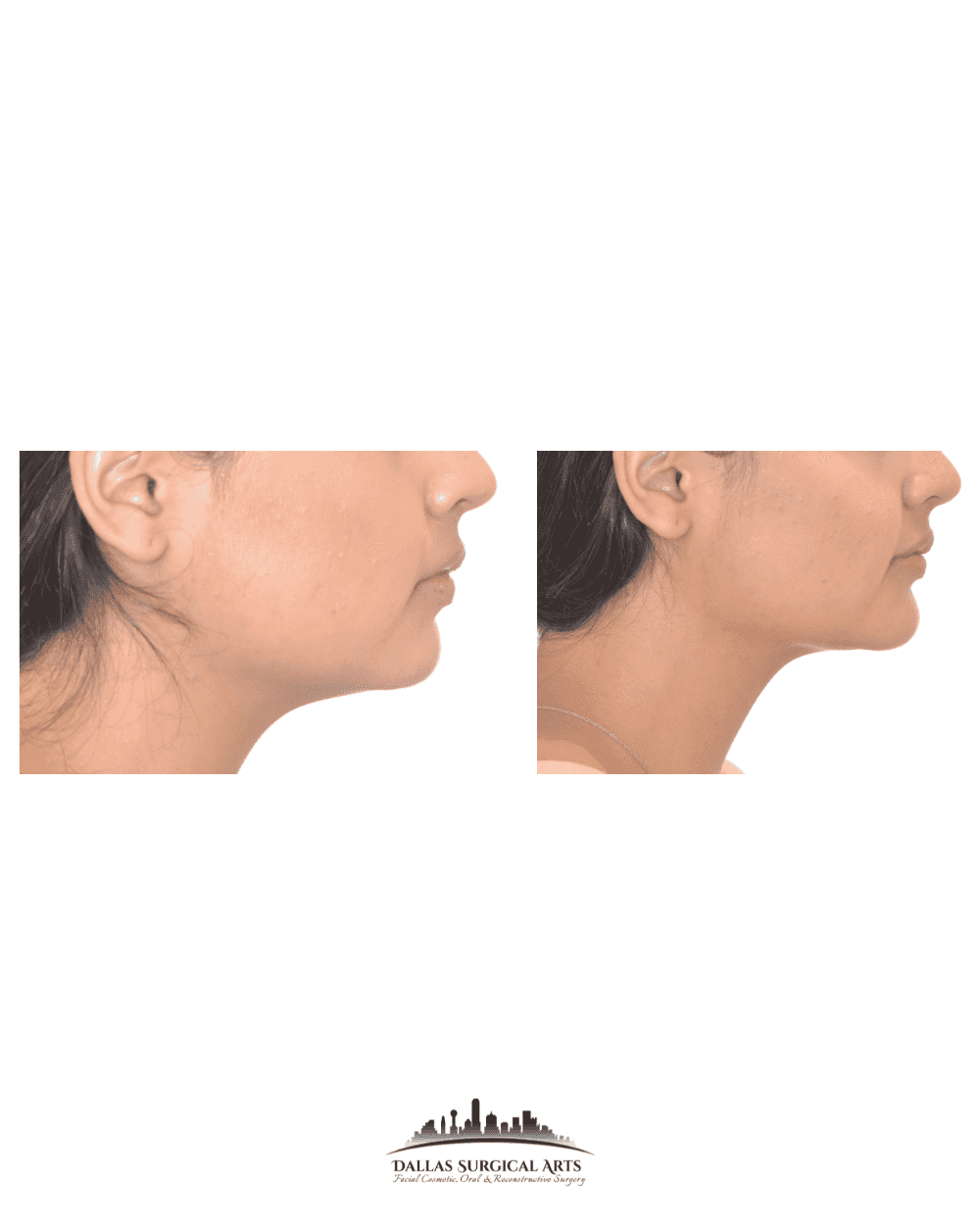 Understanding the Placement of Chin Implants by Dr. Randy Sanovich