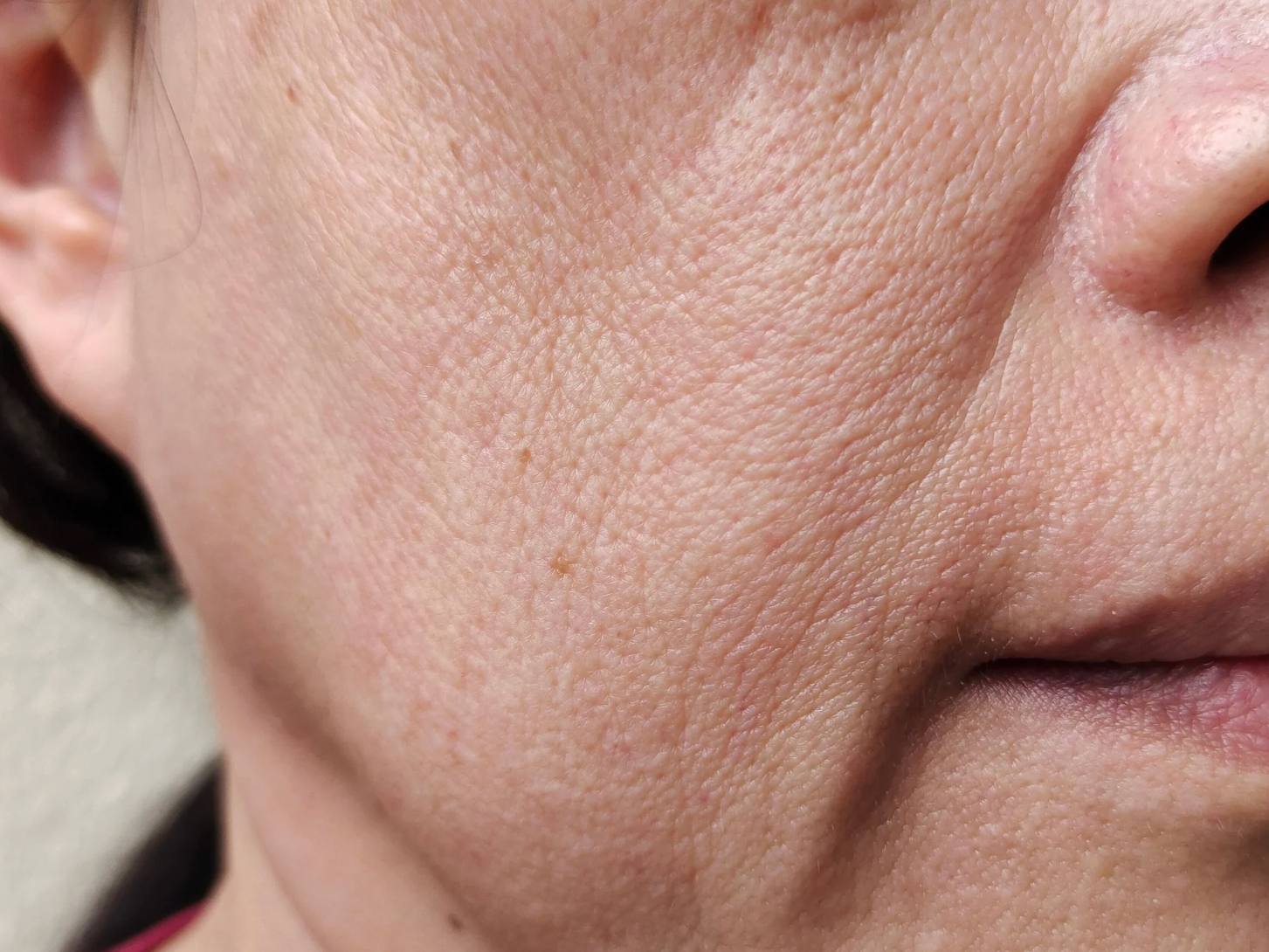 How to Get Rid of Marionette Lines: Best Treatments and Prevention Tips