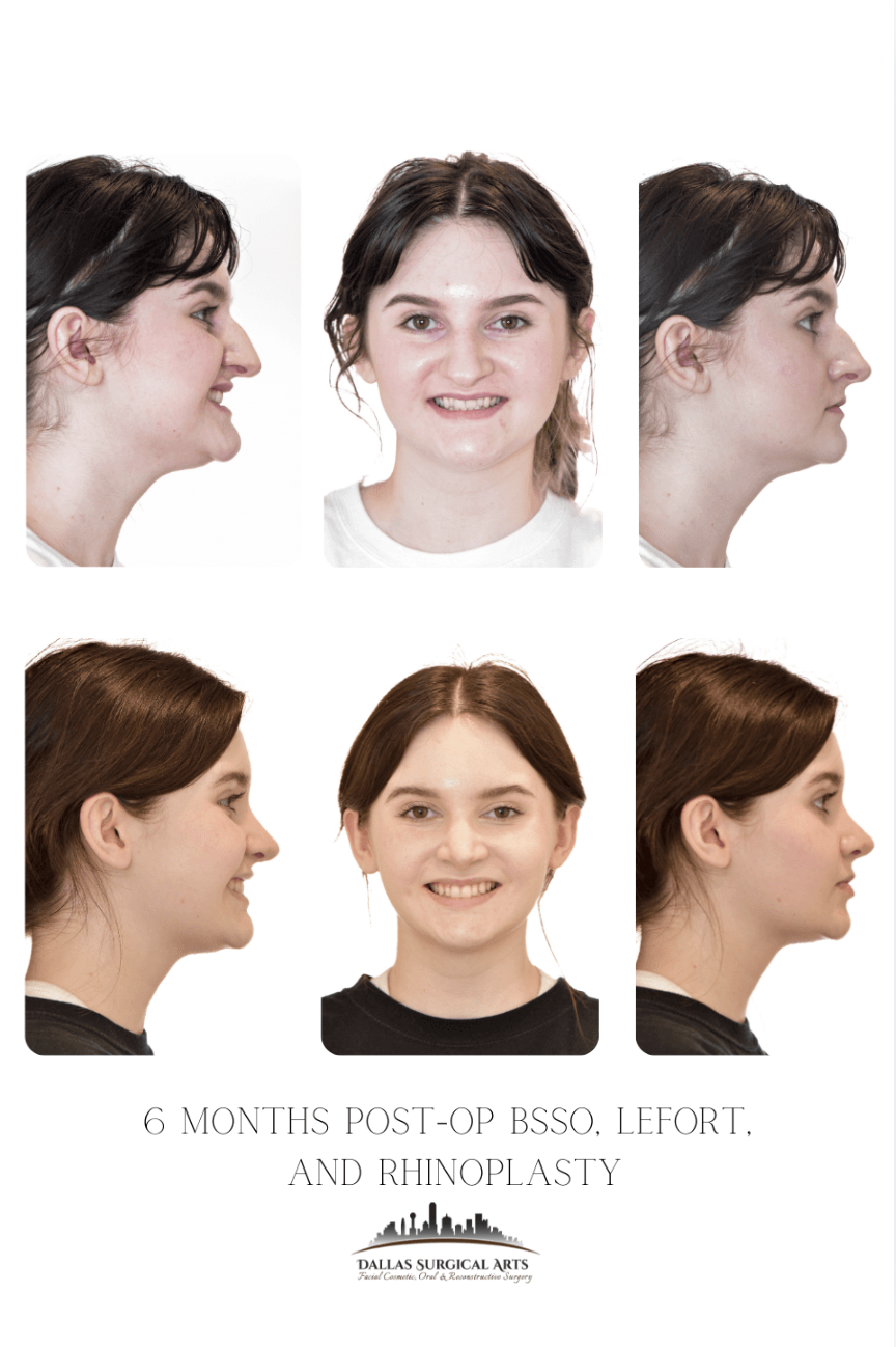 What You Might Not Know About Jaw Surgery - Orthognathic Surgery with Dr. Randy Sanovich