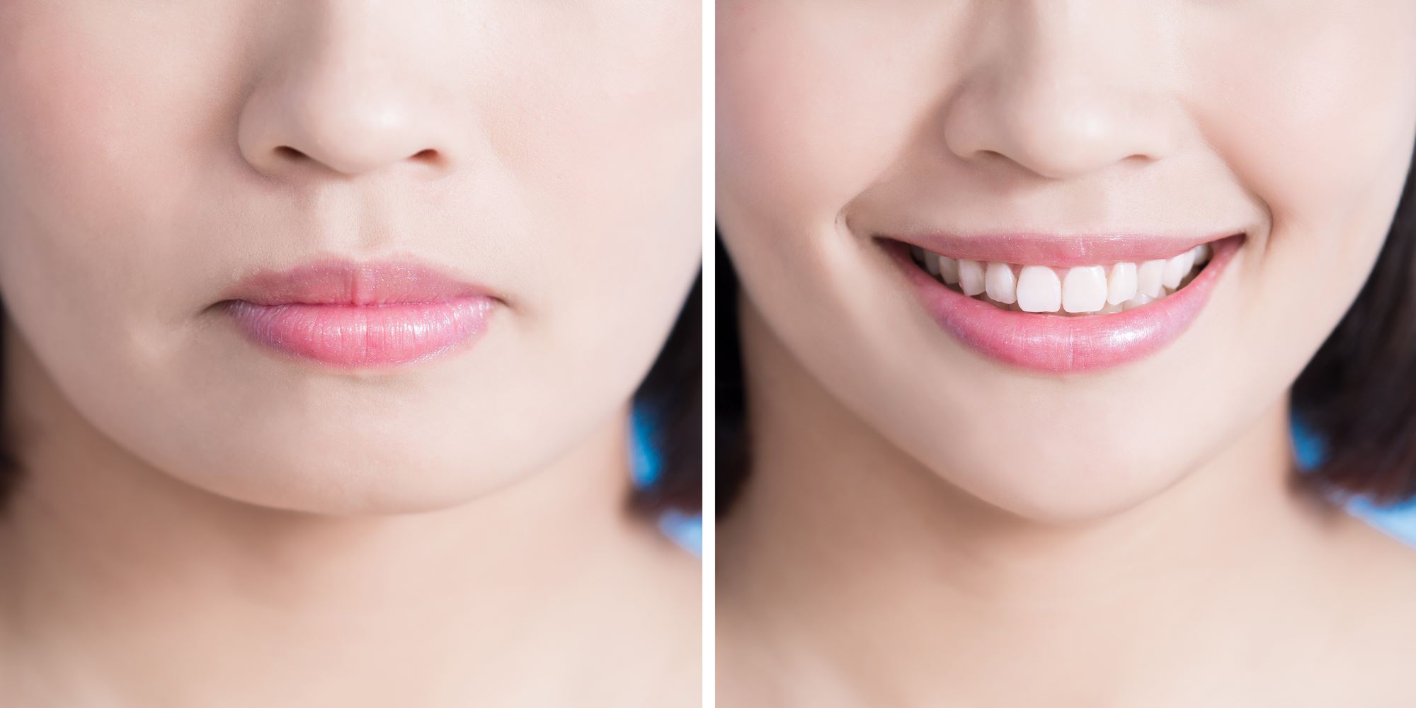 woman with jaw surgery on tip of chin