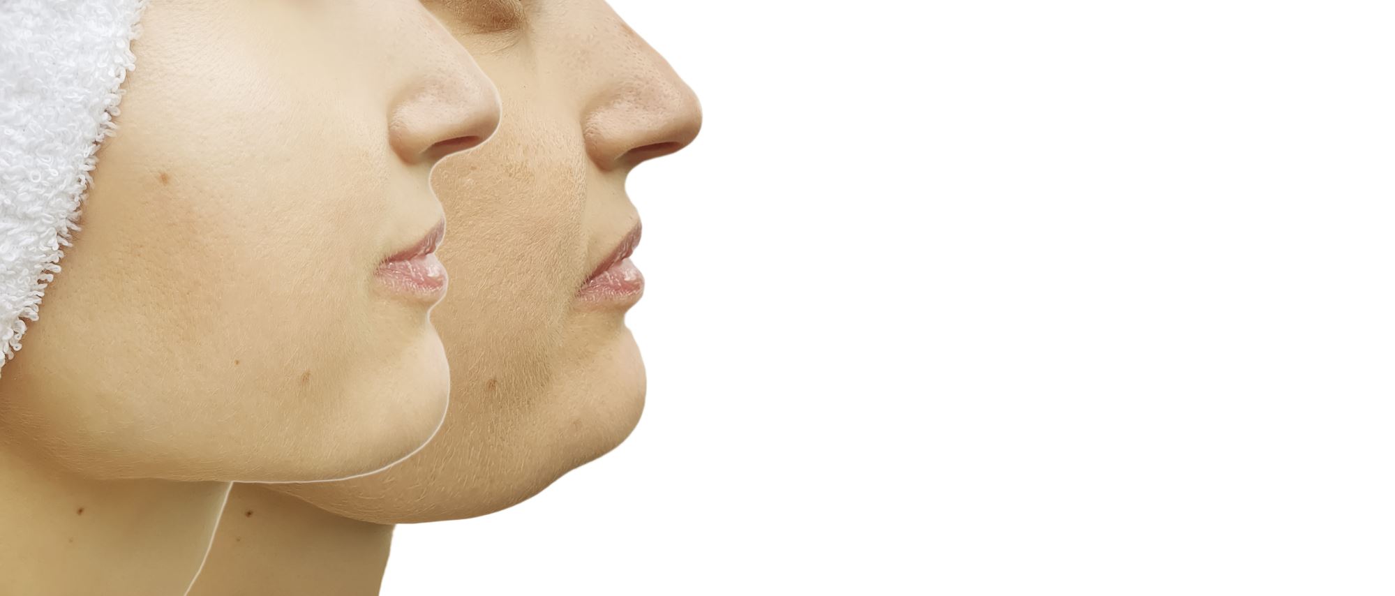 profile of a young woman before and after neck lipsuction