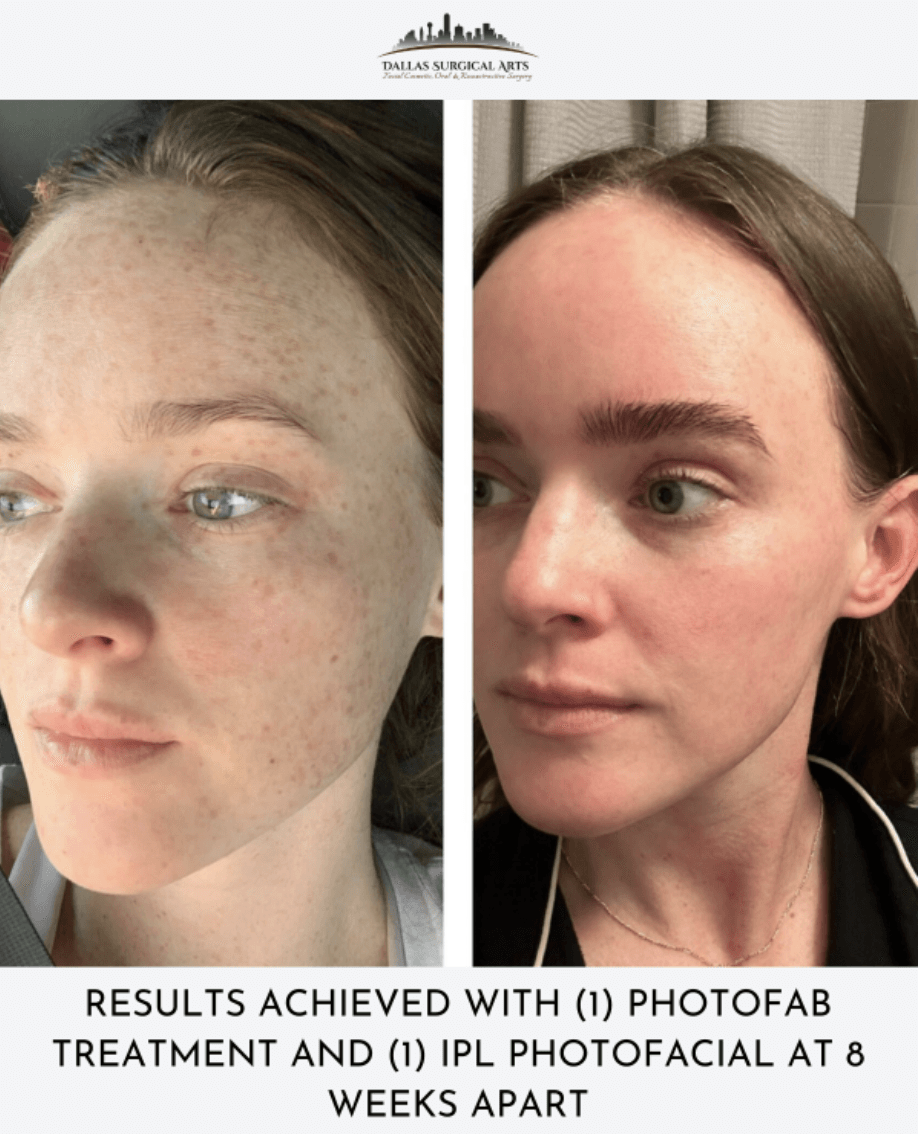Dallas Treatment for Hyperpigmentation: Photofabulous (IPL and Photofractional Laser)