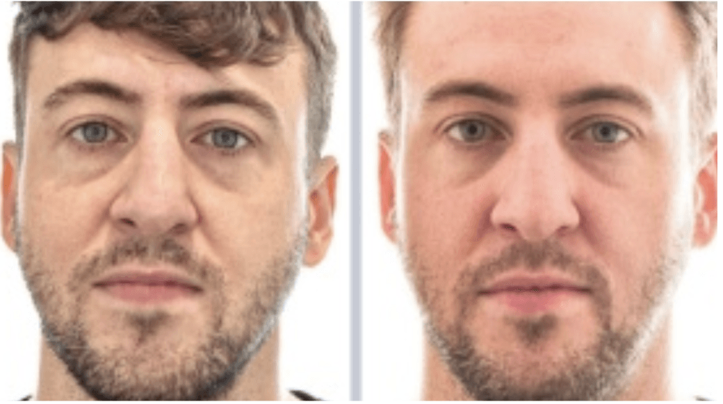 Under Eye Filler - Restylane Eye Light in Dallas with Dr. Sanovich