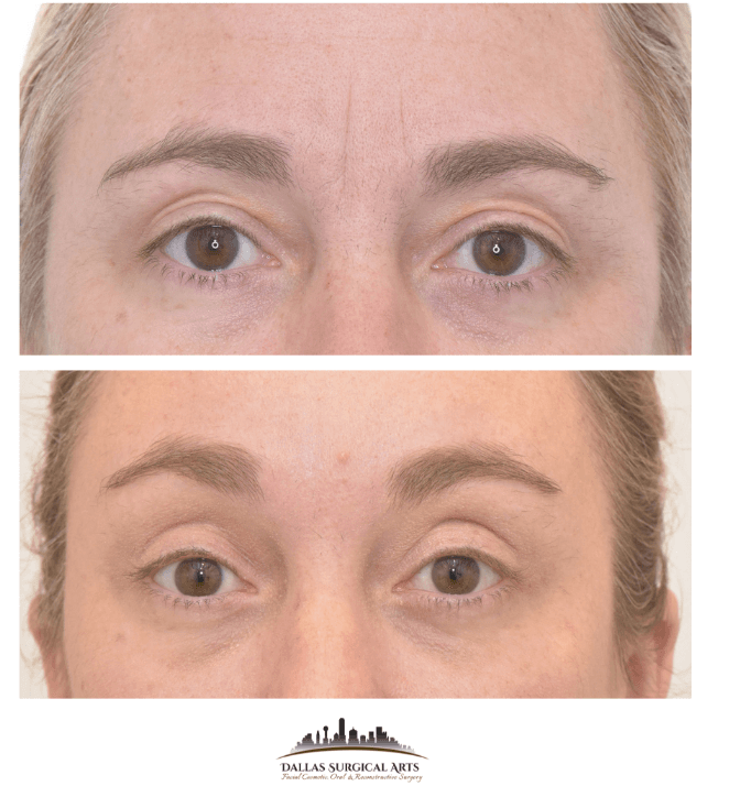 Dallas Endoscopic Brow Lift with Dr. Randy Sanovich