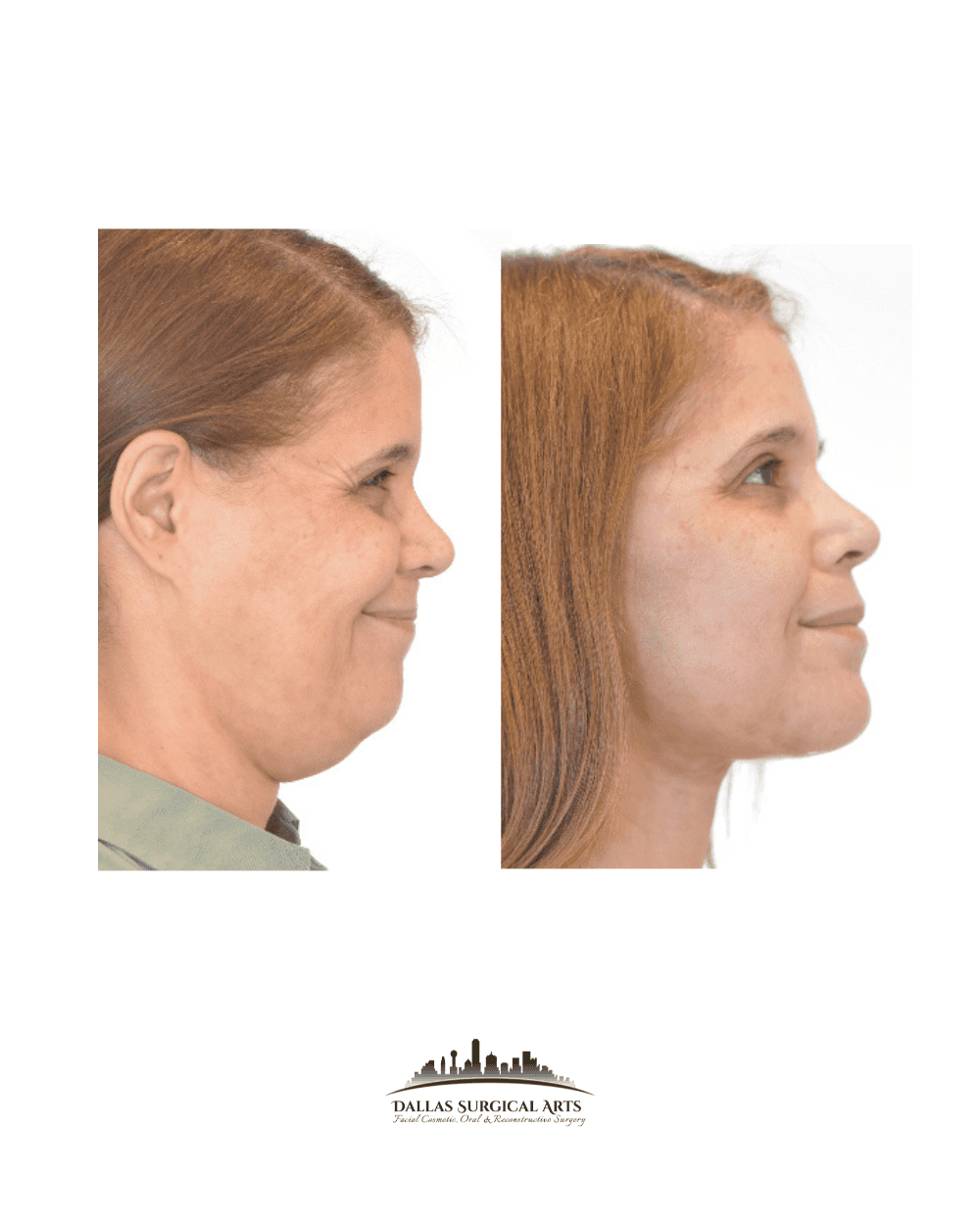 Facial Rejuvenation with a Facelift: Understanding the Different Types of Facelifts and Their Benefits- Midface Lift at Dallas Surgical Arts with Dr. Randy Sanovich