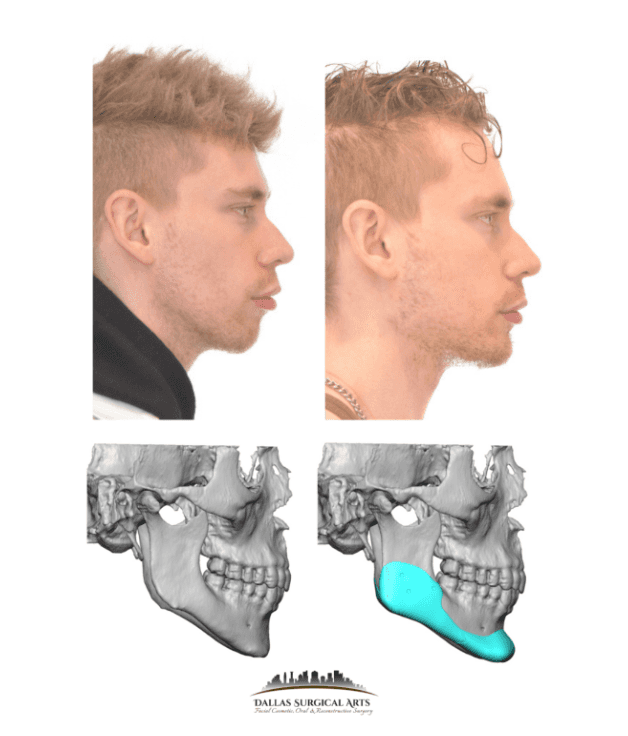 Dallas Facial Contouring and Implants: Frequently Asked Questions Addressed