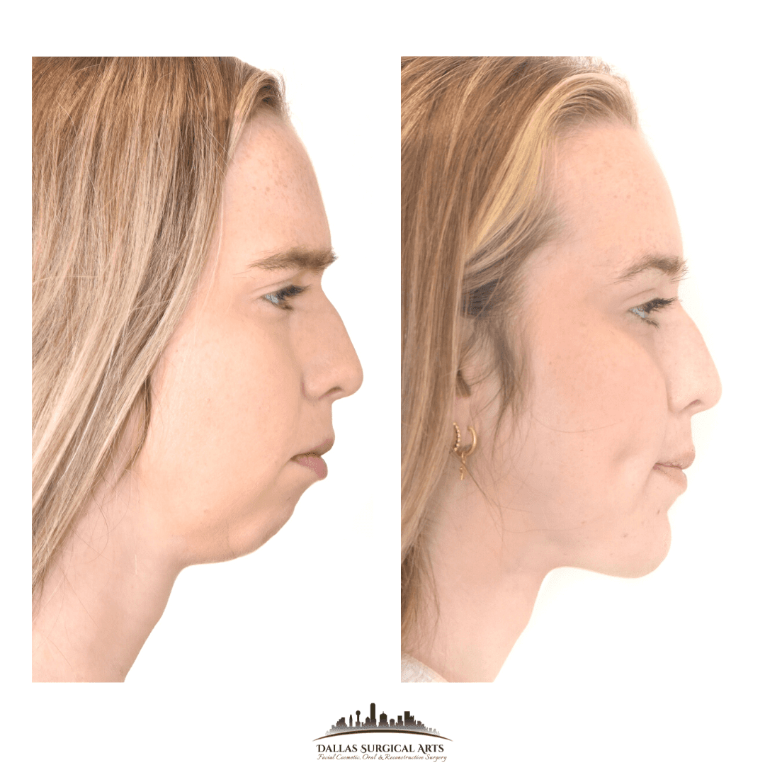 Genioplasty at Dallas Surgical Arts Chin Surgery in Dallas