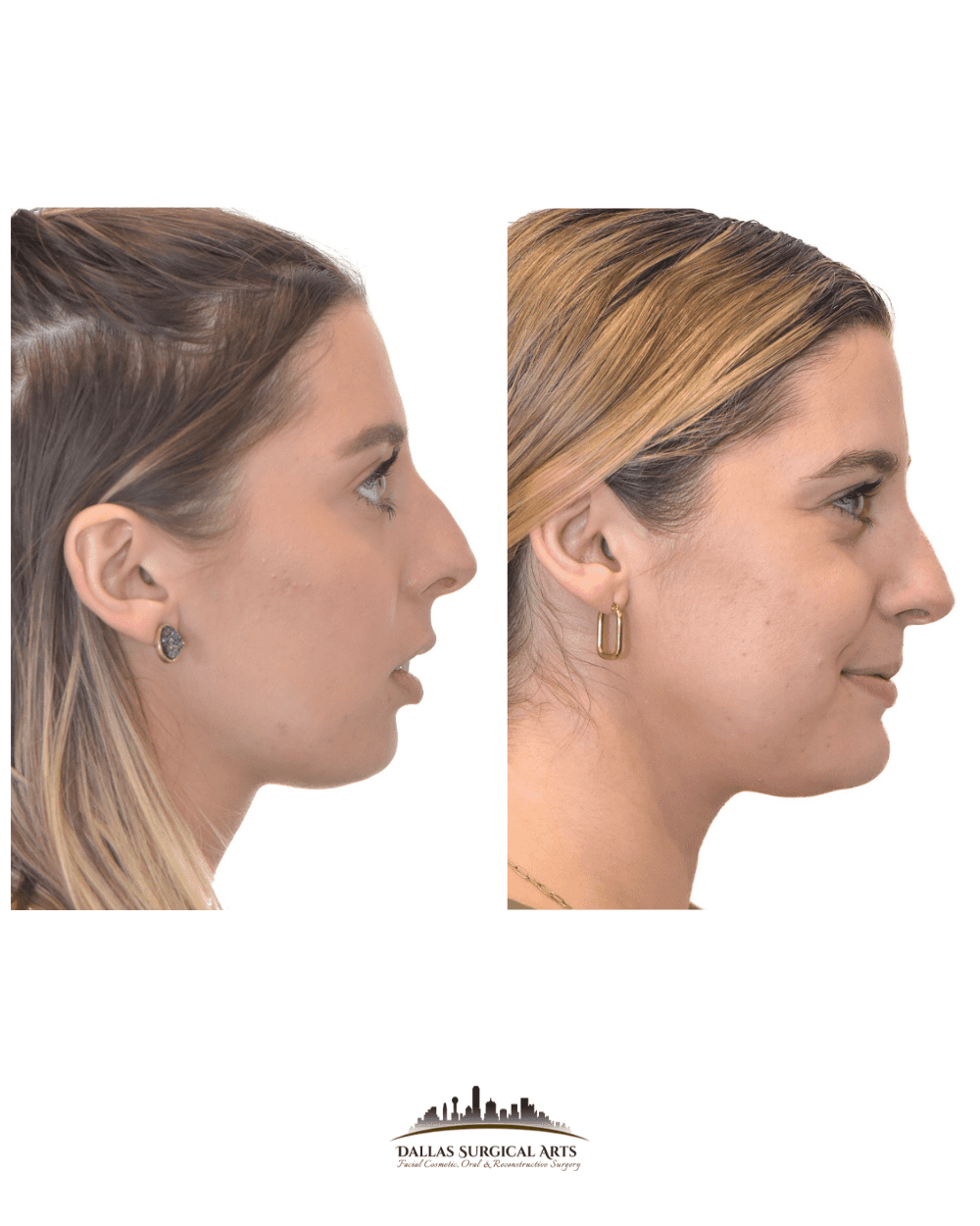 Enhancing Your Jawline: Treatments at Dallas Surgical Arts with Dr. Randy Sanovich