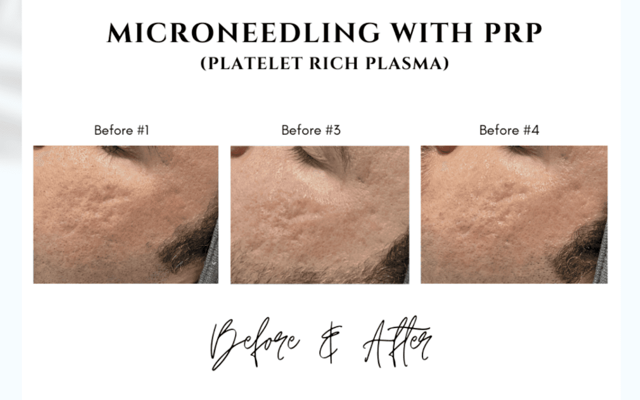 Microneedling with Hyaluronic Acid vs. PRP Exploring Skin Rejuvenation