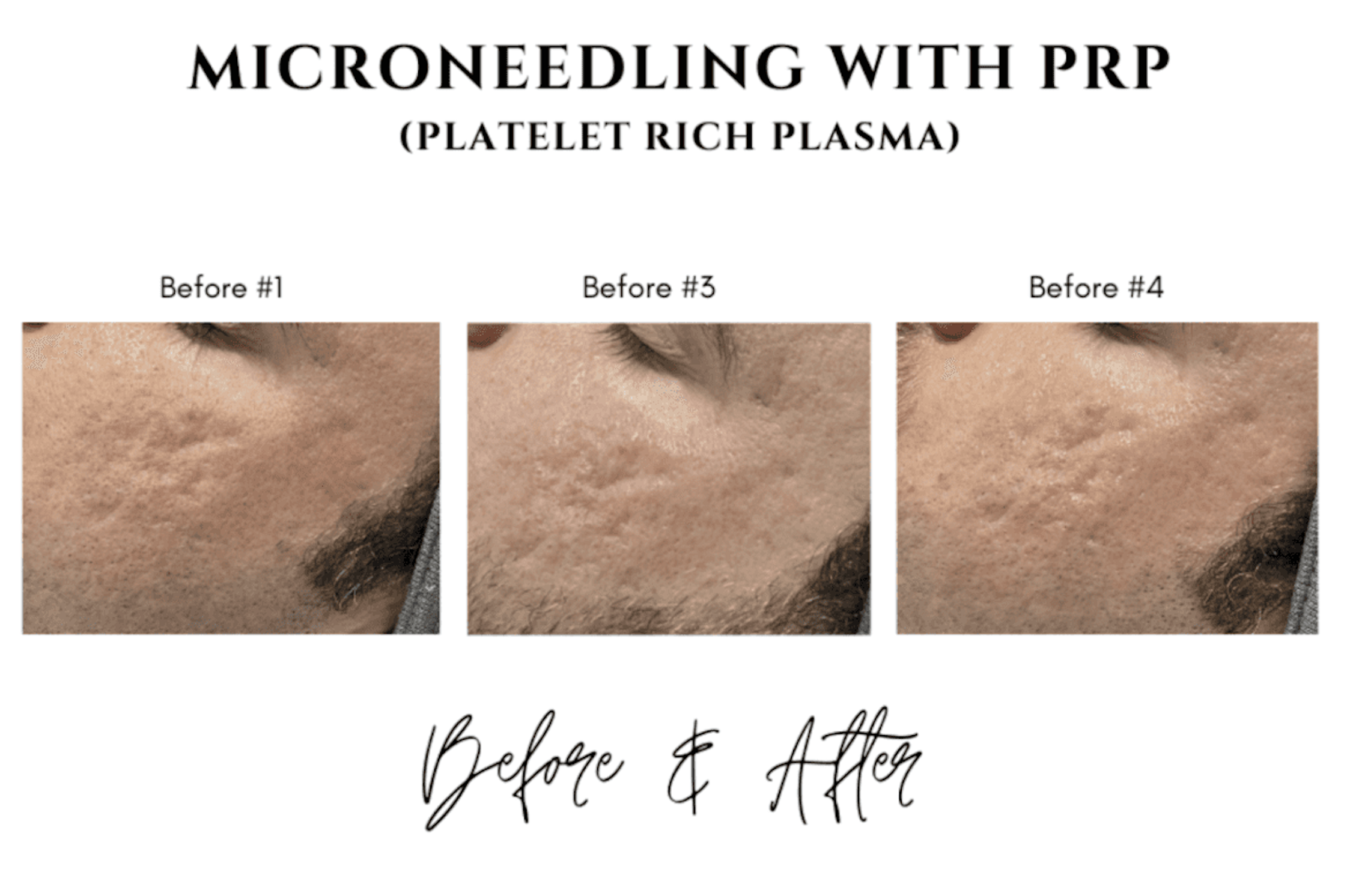 Microneedling with Hyaluronic Acid vs. PRP: Exploring Skin Rejuvenation Options