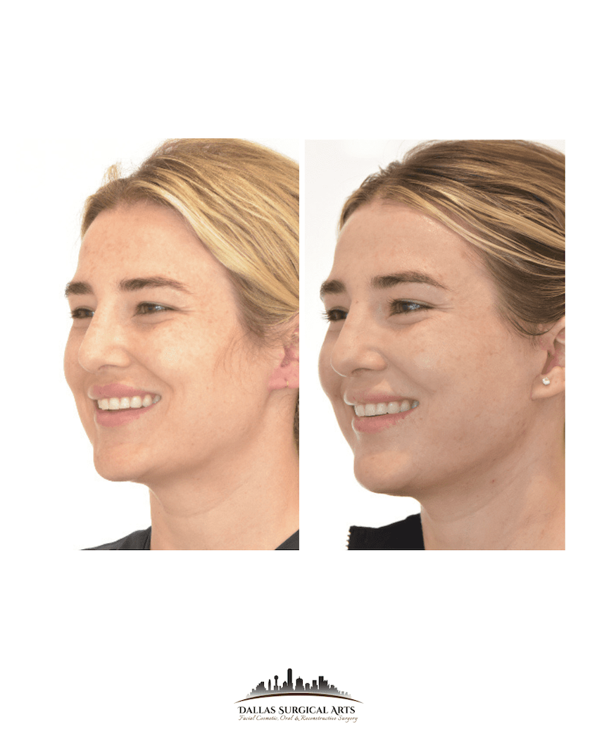Understanding the Mini Facelift at Dallas Surgical Arts