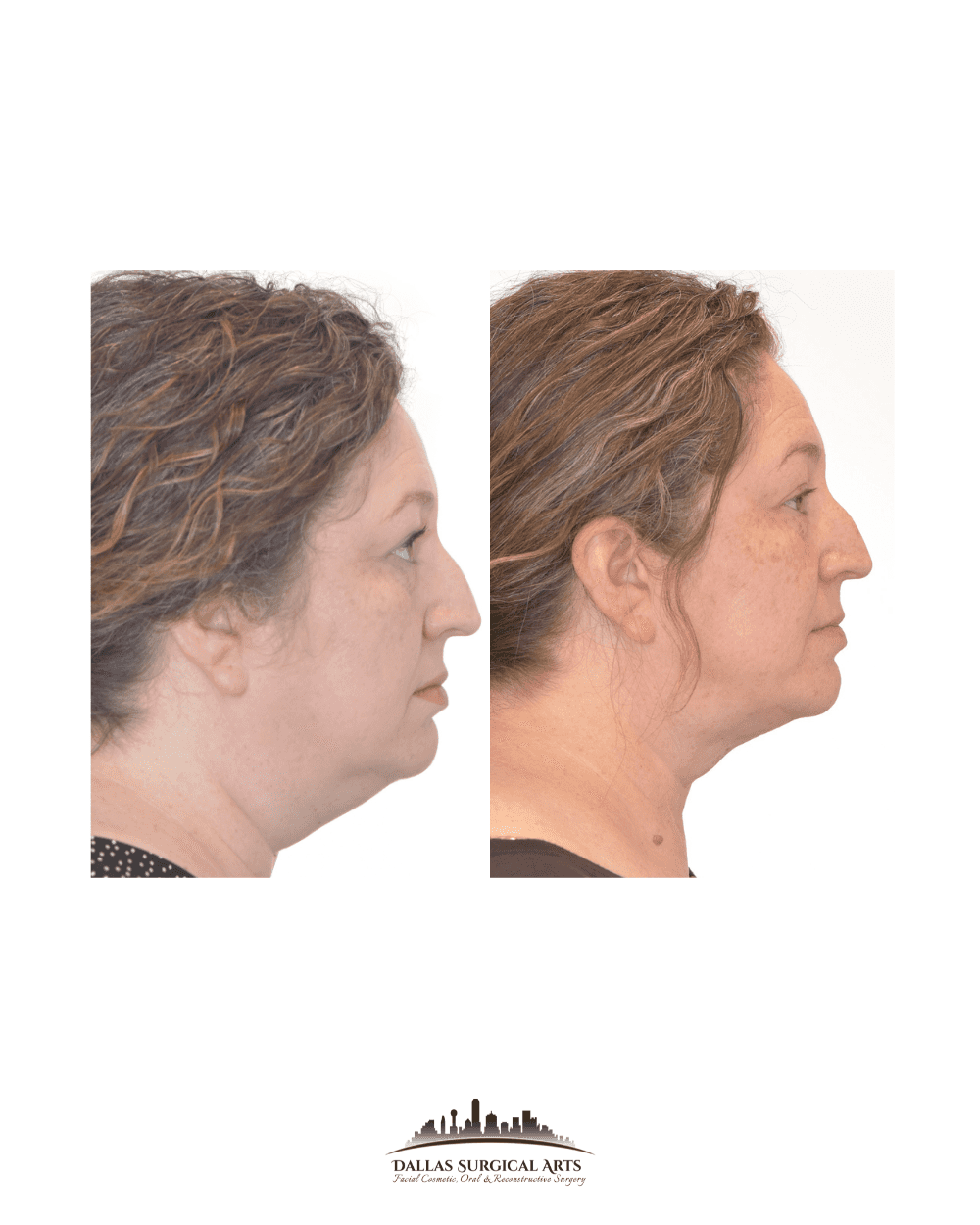 Neck Liposuction in Dallas - Popular Cosmetic Surgery in 2023 at Dallas Surgical Arts