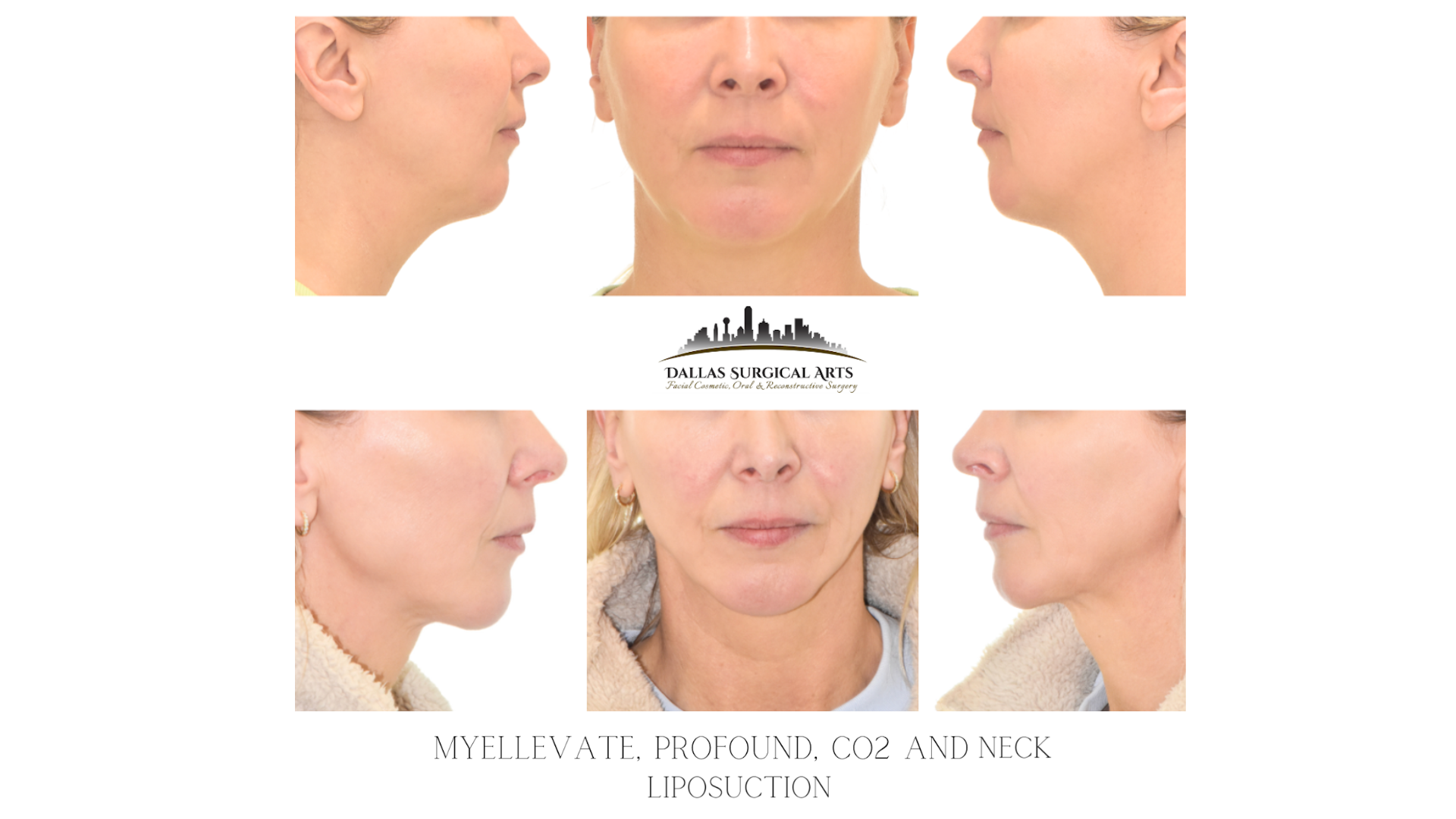 How to Get Rid of A Double Chin - Neck Liposuction in Dallas