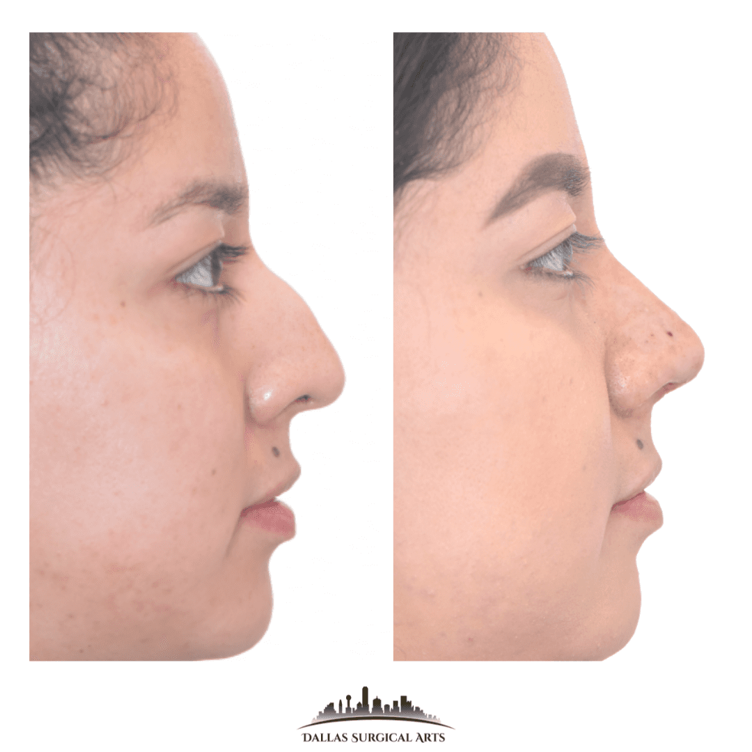 Addressing the Nose Bridge with Rhinoplasty by Dr. Randy Sanovich