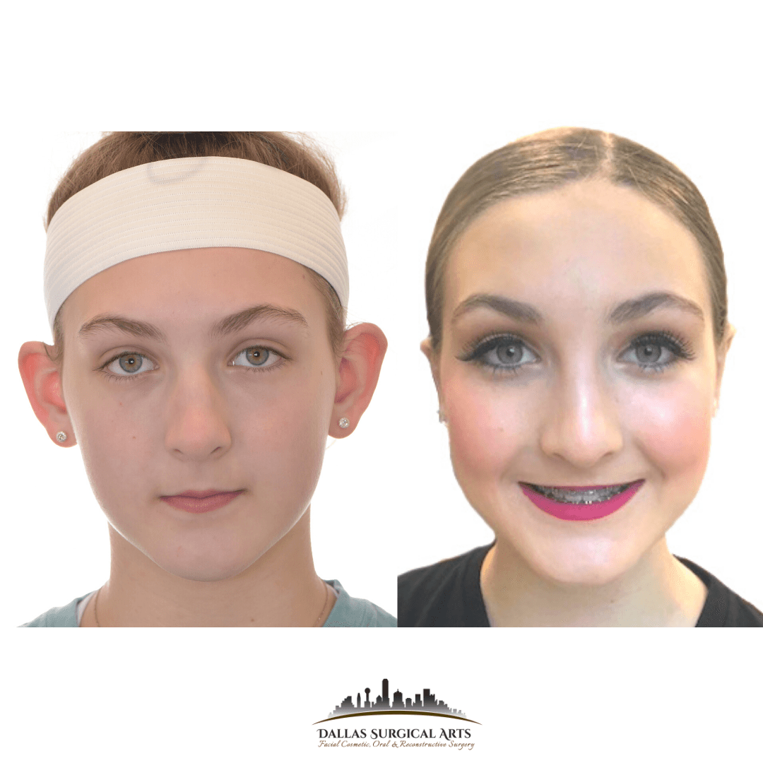 Common Reasons for Ear Pinning Surgery in Dallas with Dr. Randy Sanovich