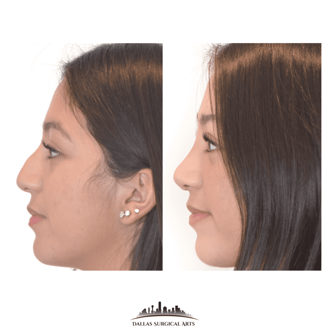 Rhinoplasty Dallas: Achieve Your Ideal Nose with Dr. Randy Sanovich