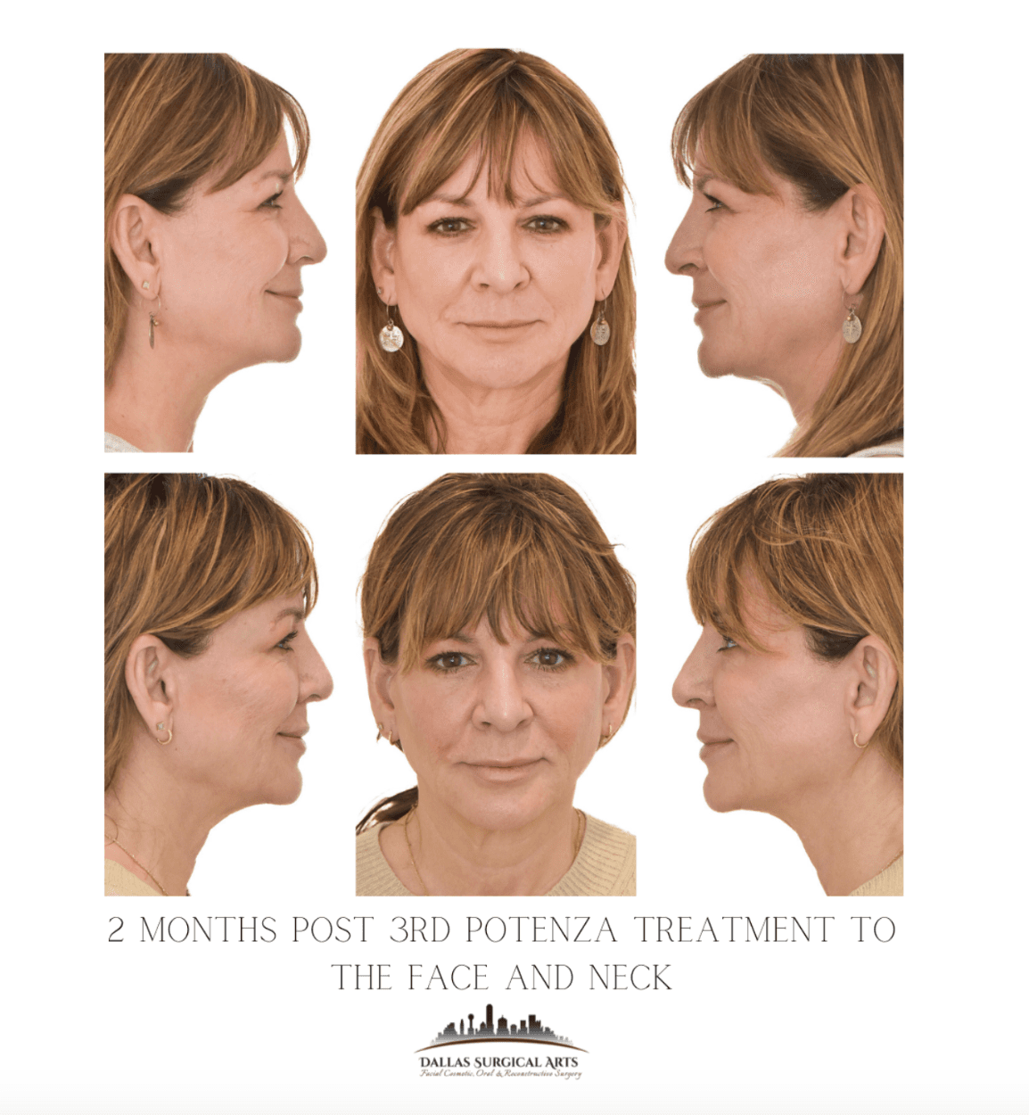Eliminate Double Chin: Discover Potenza at Dallas Surgical Arts