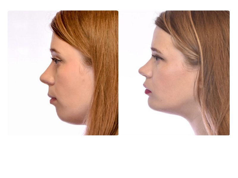 Jaw Surgery before and after
