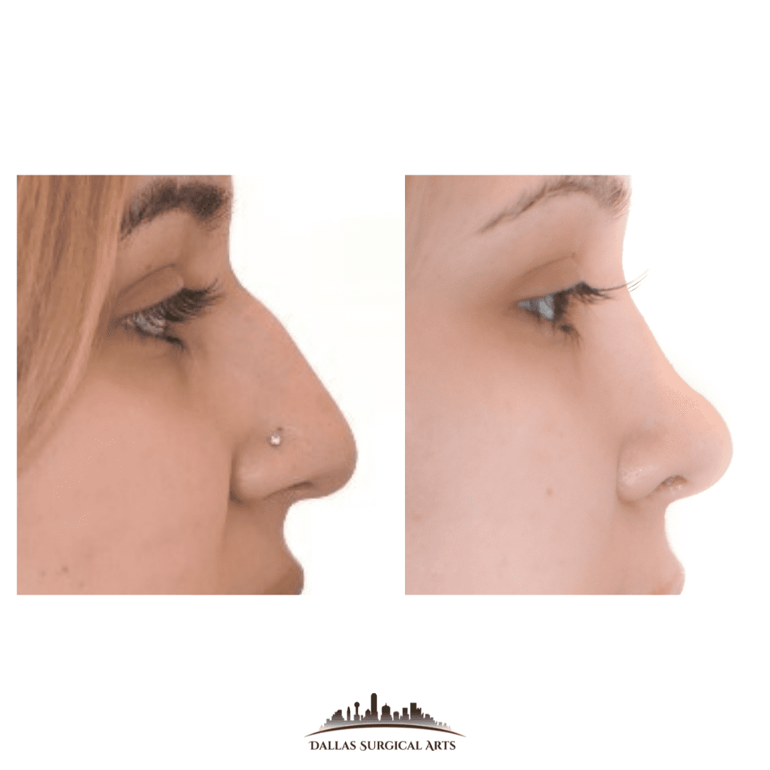 Dallas Cosmetic Surgery- Popular Procedures by Dr. Randy Sanovich