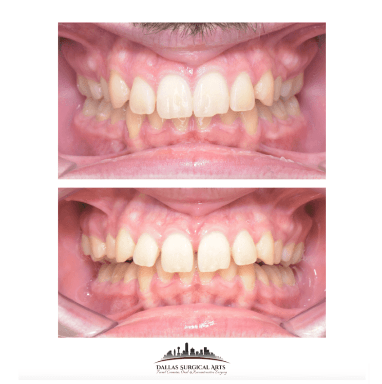 SARPE/EASE Surgery in Dallas Explained