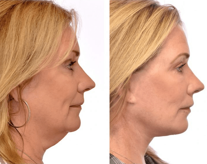 woman after getting face-lift