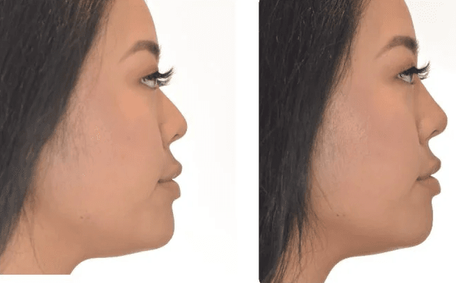 before and after rhinoplasty