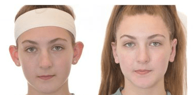 child after otoplasty