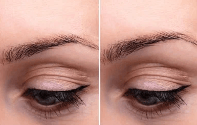 brow lift