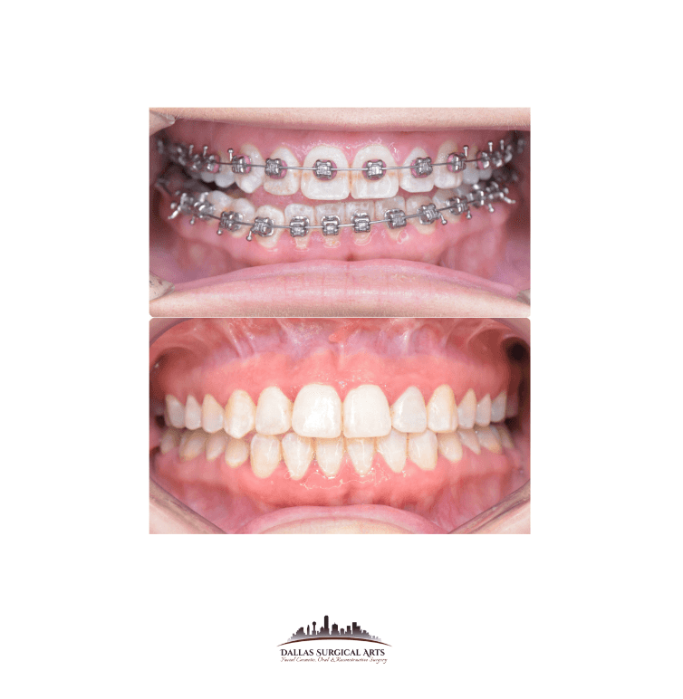 TMJ Replacement at Dallas Surgical Arts: Restoring Comfort and Functionality