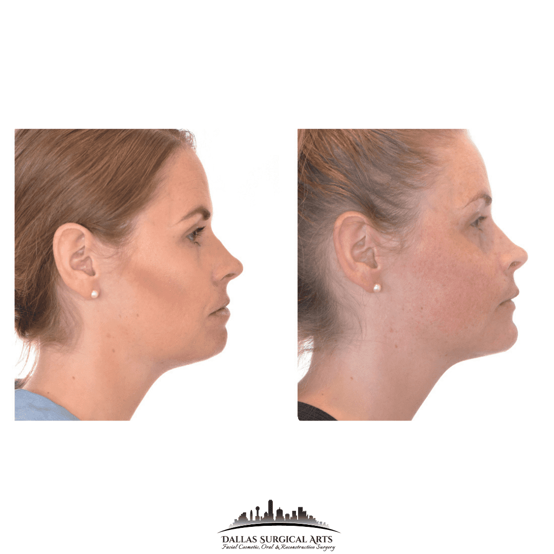 Total Joint Replacement Surgery - TMJ Treatment in Dallas