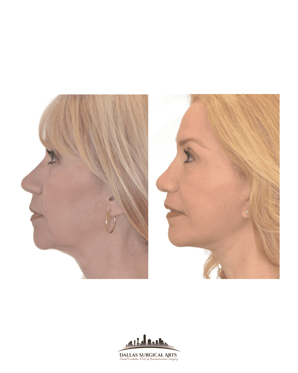 Total Joint Replacement FAQs - Answers to Common Questions