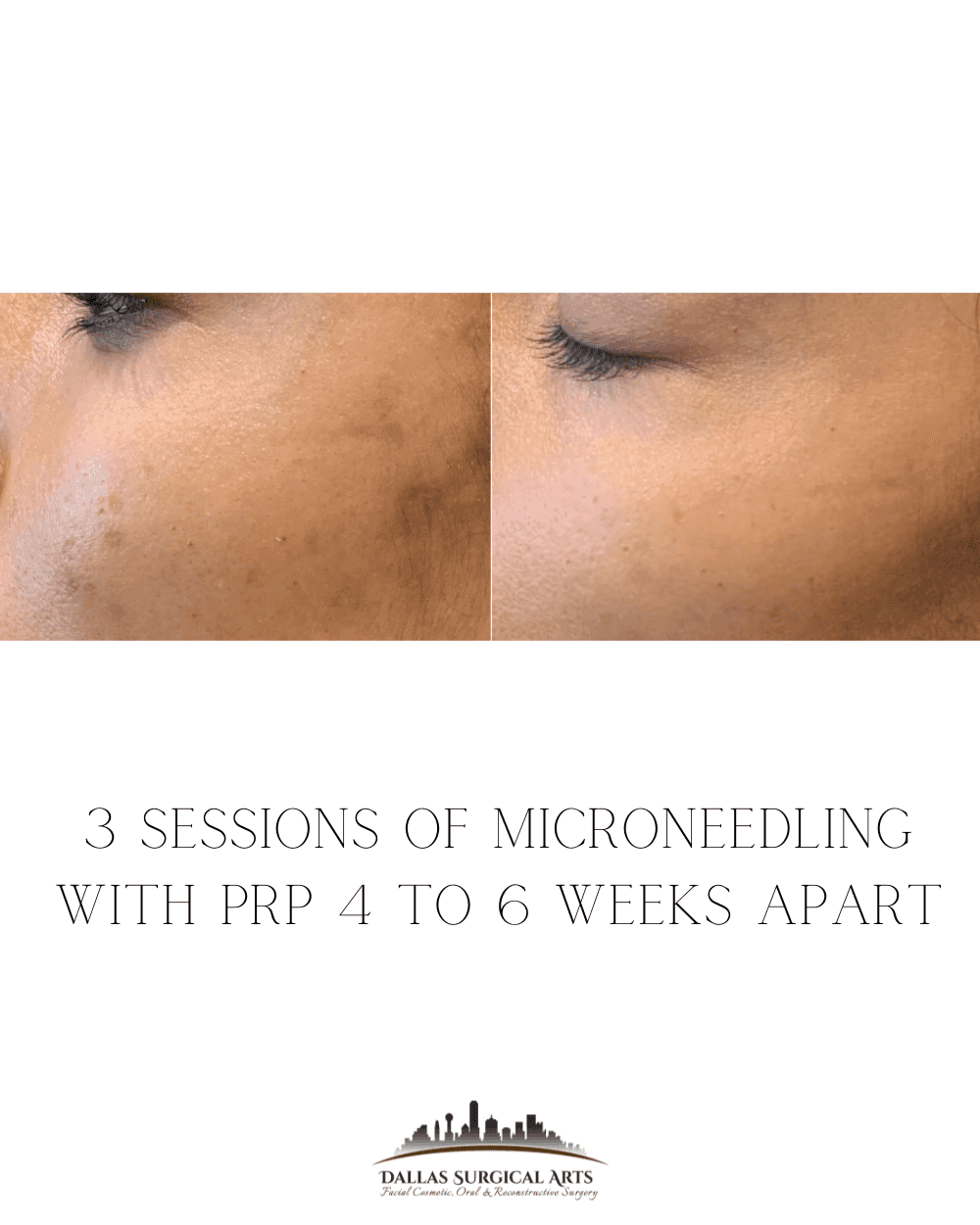 Melasma Awareness Month - Melasma Treatment in Dallas