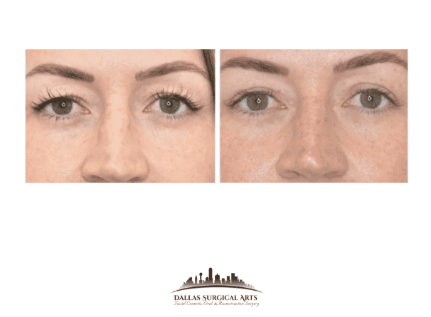 Choosing the Right Cosmetic Surgeon, Best Blepharoplasty Surgeon in Dallas