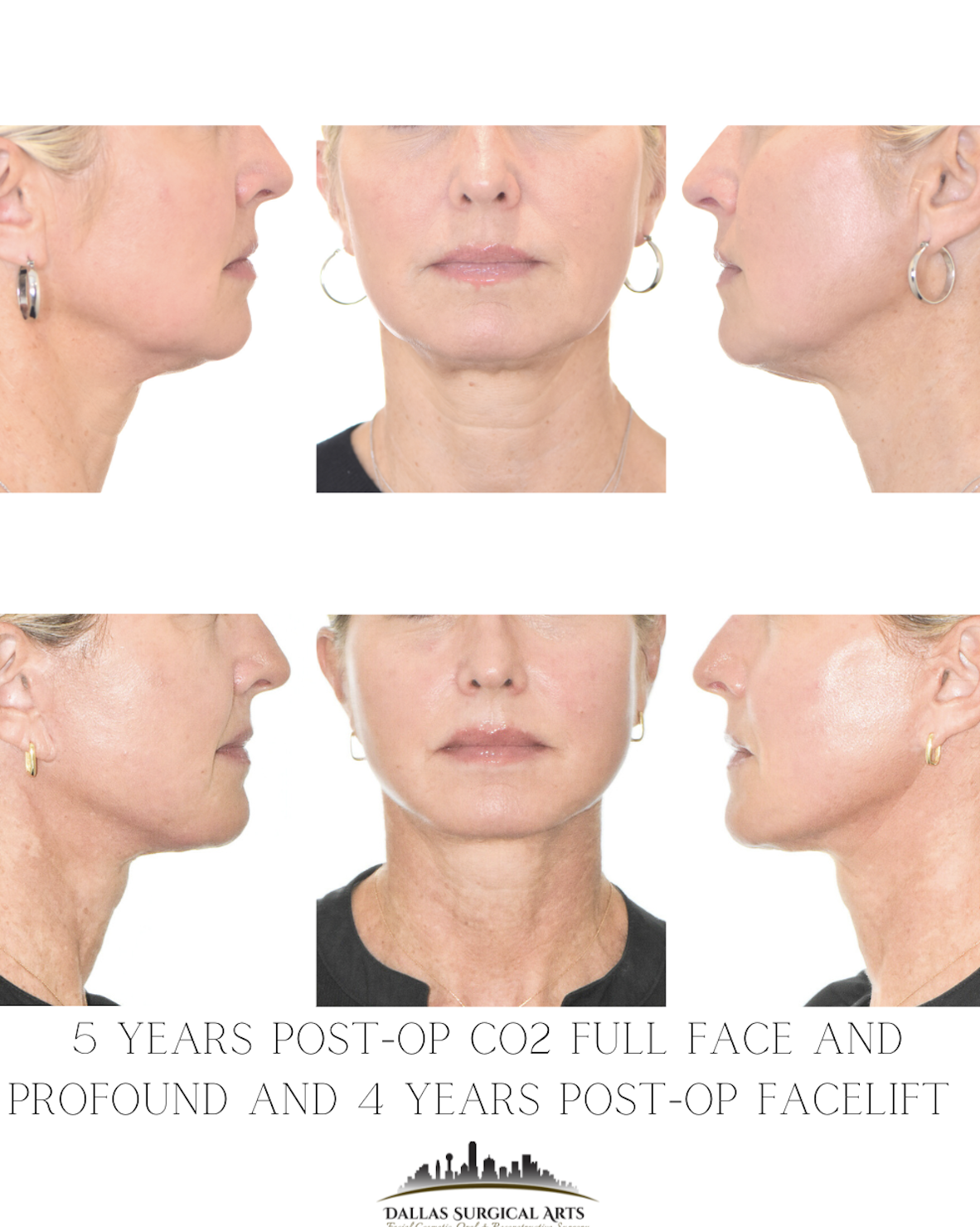 Looking Younger Starts Here: All About Fractional CO2 Laser Treatment