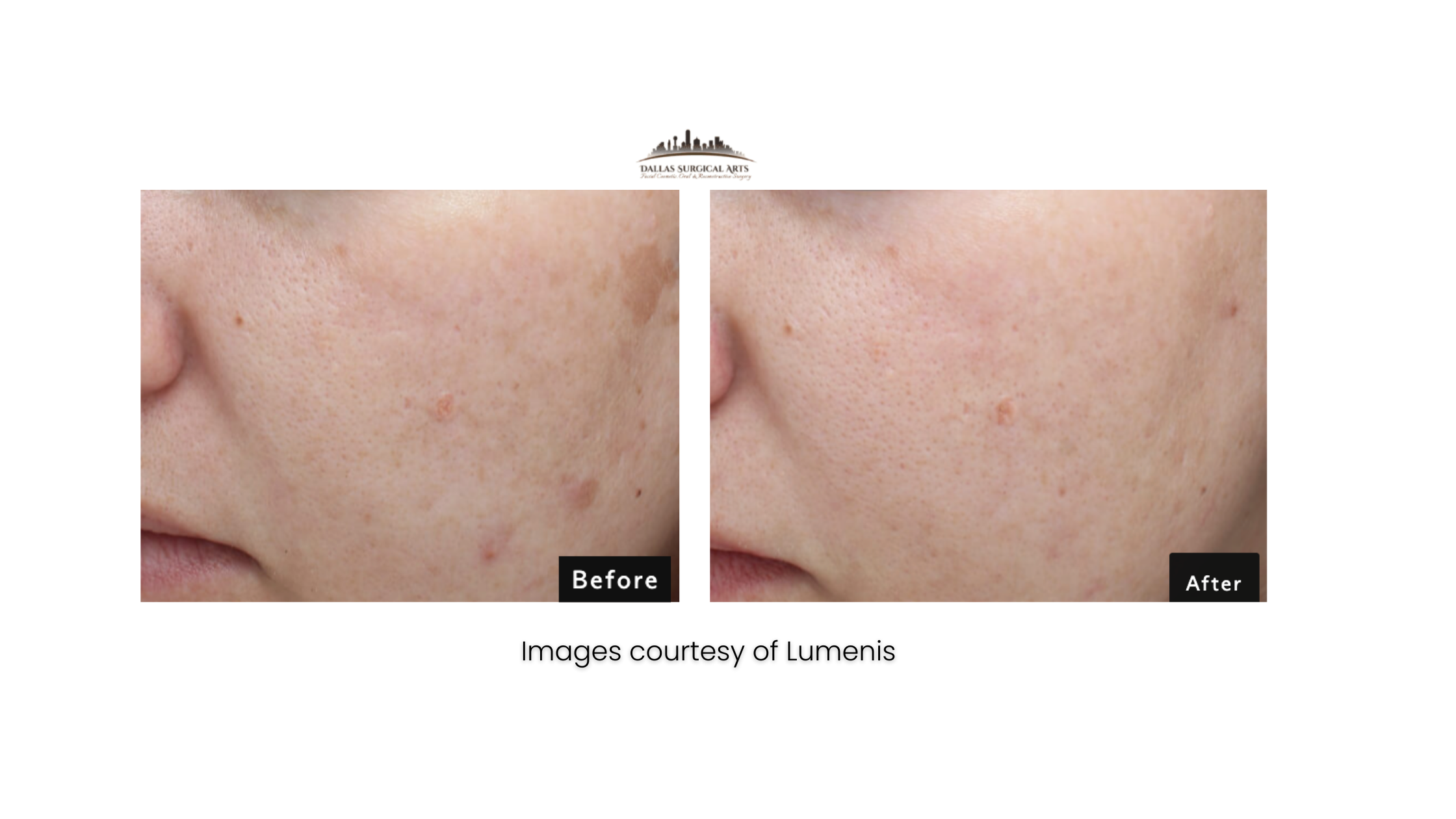 Are Laser Treatments Effective? Why We Love the Stellar M22™ Q-Switch Laser