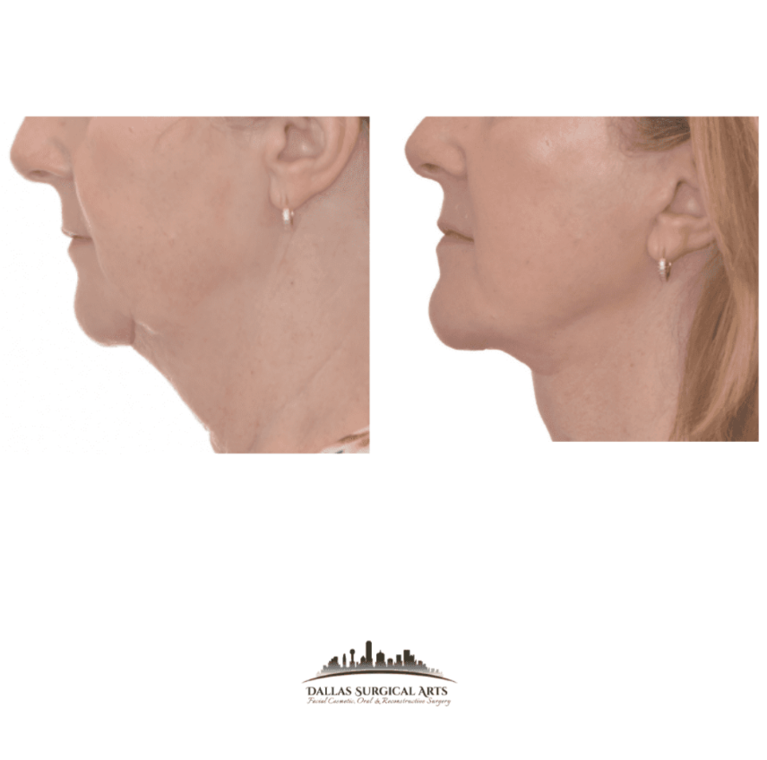 Deep Plane Facelift vs. Traditional Facelift in Dallas