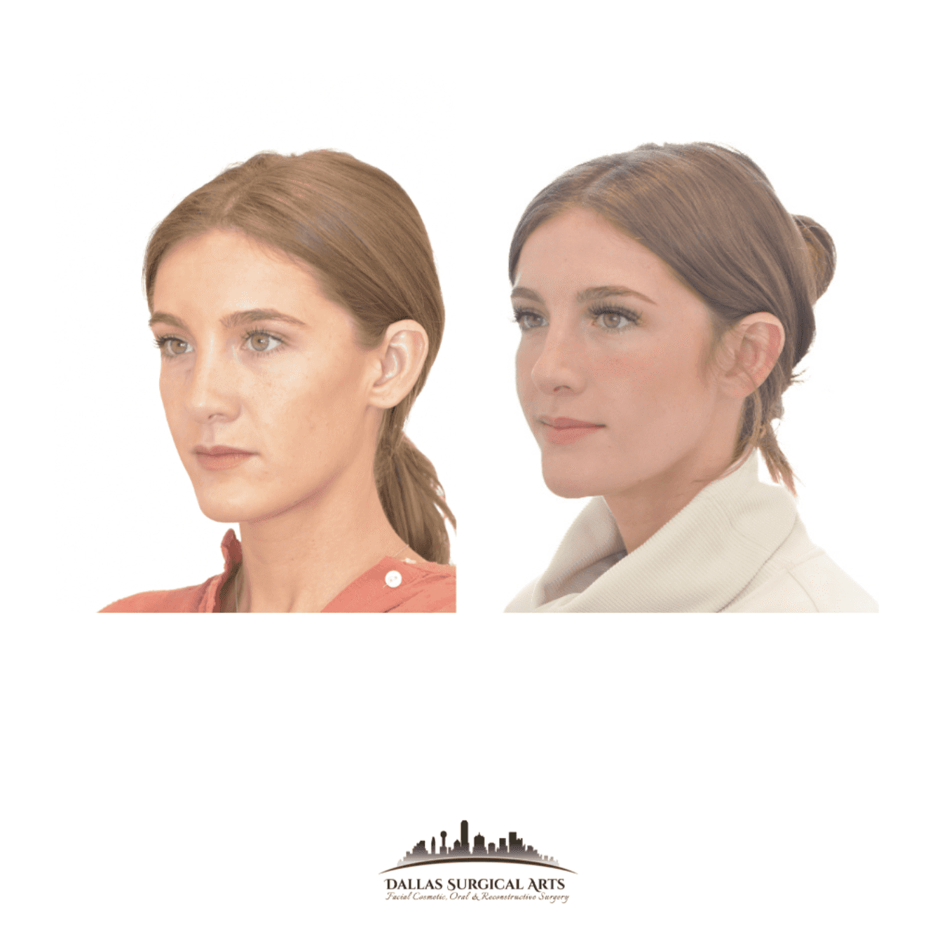 Enhance Your Profile with Genioplasty and Lower Face Contouring Surgery in Dallas